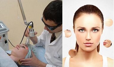 Yaya ake yin gyaran fata na Laser